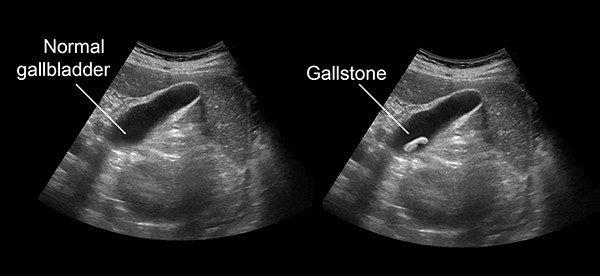 gallbladder removal icd 10