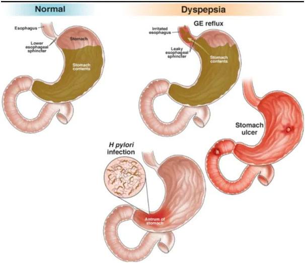 Gastroscopy Caboolture Gastroesophageal Reflux Disease North Lakes 